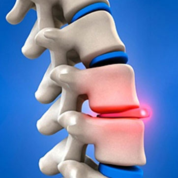 Can A Herniated Disc Cause the Problem of Sciatica?