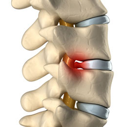 Know How Microdiscectomy Helps In Relieving Pain