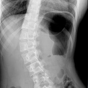 Scoliosis specialist in Delhi can proficiently alter the shape of your spine for treating the problem of Scoliosis